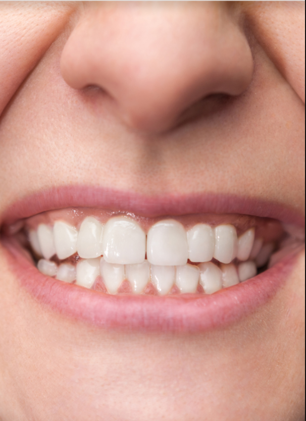 Dental crowns — before